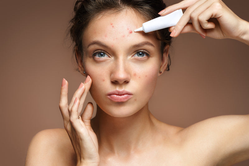 The Worst Foods to Eat With an Acne Flare-Up and What to Eat Instead